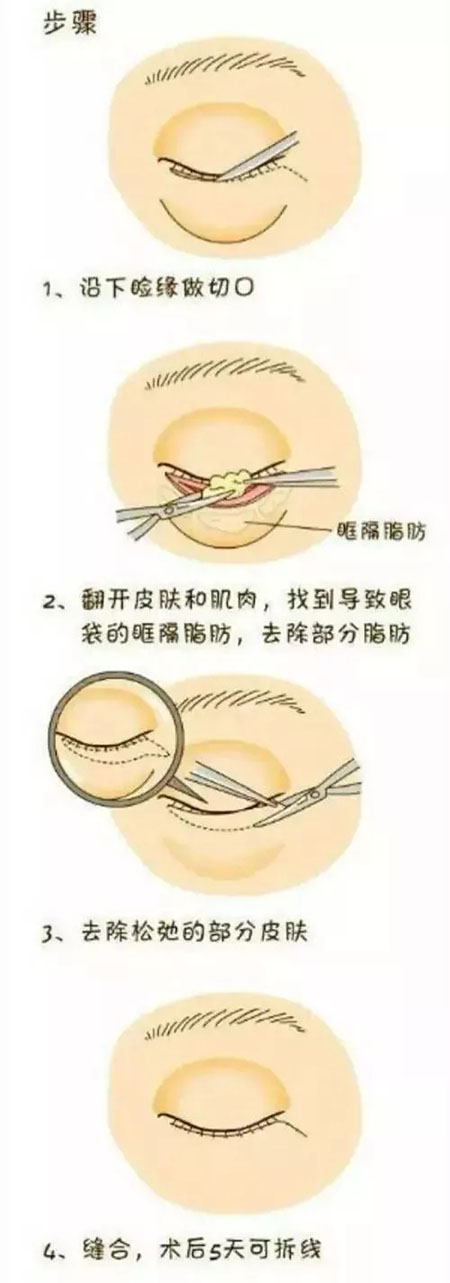 眼袋有多深你就有多老，祛眼袋一定要趁早！
