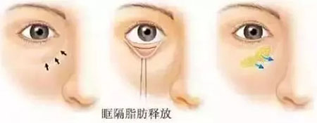 眼袋有多深你就有多老，祛眼袋一定要趁早！