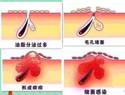New&New|比春敏更痛苦的事...不要讓爆痘毀了你的臉！