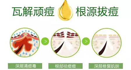 New&New|比春敏更痛苦的事...不要讓爆痘毀了你的臉！