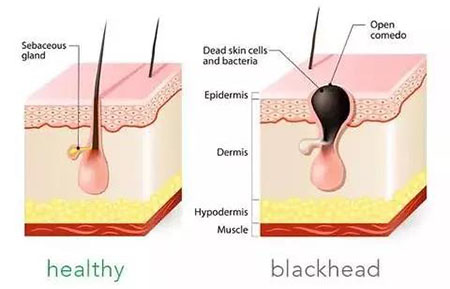 黑頭總是去不掉？這可能是 全 有效的去黑頭指南了！