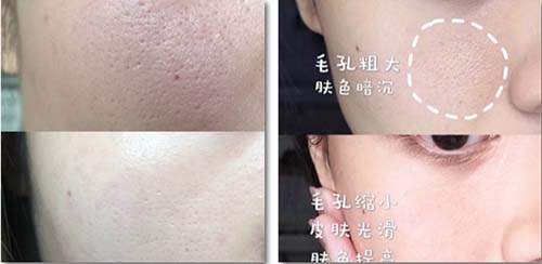 收縮毛孔、祛除皺紋