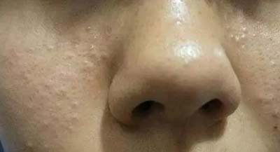 皮膚吸收不暢、粉刺痘痘不斷，是時(shí)候做下深層清潔了