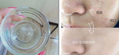 皮膚吸收不暢、粉刺痘痘不斷，是時(shí)候做下深層清潔了