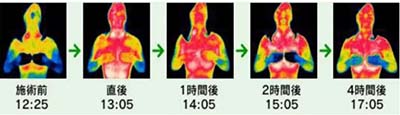 一次減3~6公分，塑形就選高周頻溶脂瘦身管理