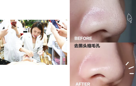 如何去黑頭？為什么要定期做去黑頭管理？VN給你好的答案