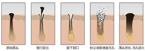 如何去黑頭？為什么要定期做去黑頭管理？VN給你好的答案