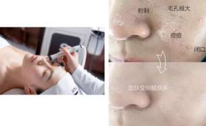 如何去黑頭？為什么要定期做去黑頭管理？VN給你好的答案