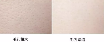 VN皮膚管理：什么皮膚問題適合做海藻煥膚？
